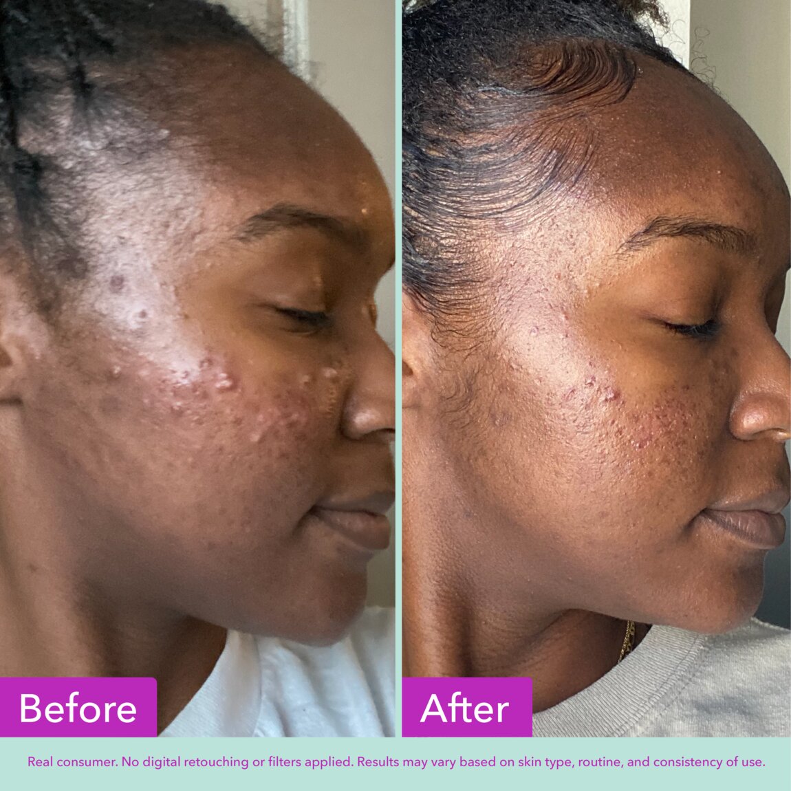 acne-foaming-cleanser-m6 zb_p.jpg