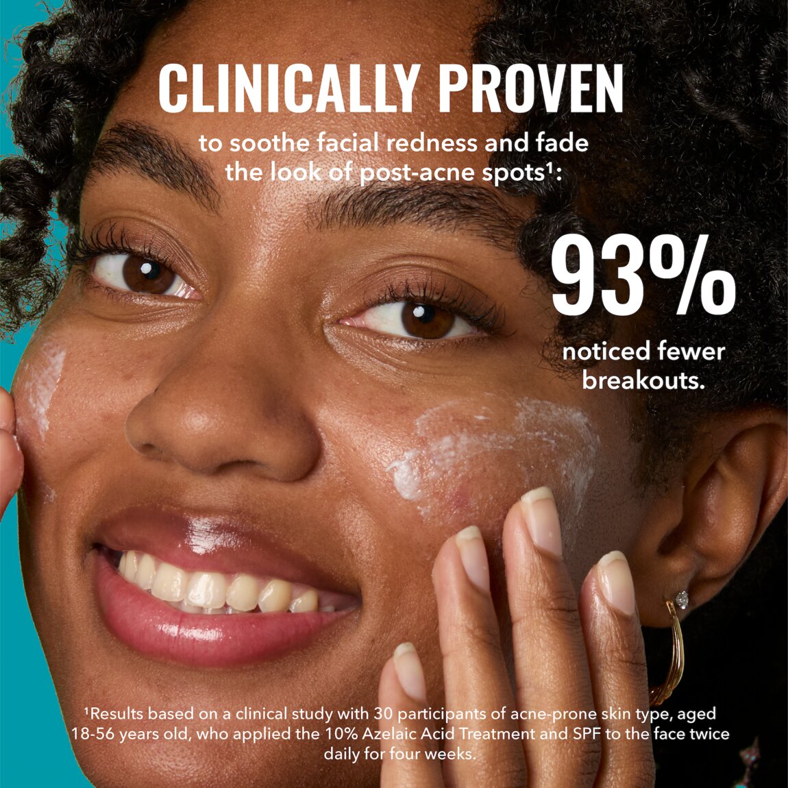 10-azelaic-acid-treatment-r3 zb_p.jpg